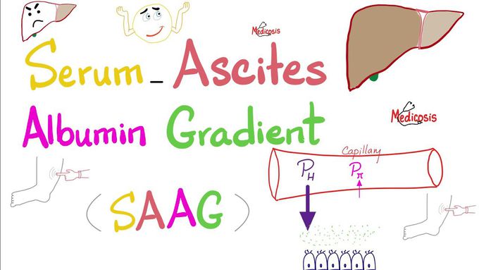 Serum Ascites Albumin Gradient (SAAG)