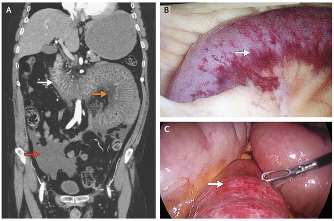 Gastrointestinal Complication of Granulomatosis with Polyangiitis