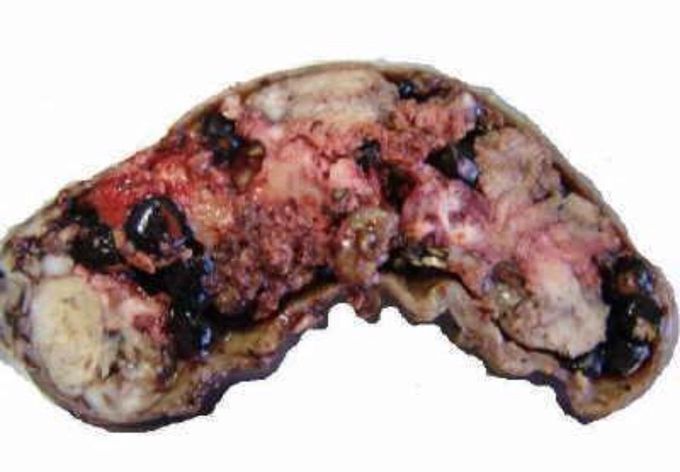 Adenocarcinoma of gallbladder