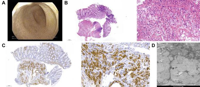 Tangier Disease