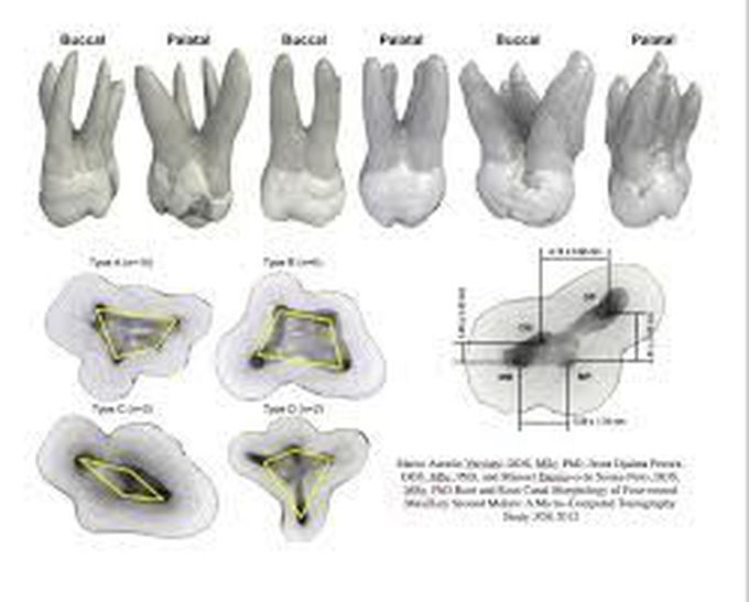 Anatomy of upper second molar roots