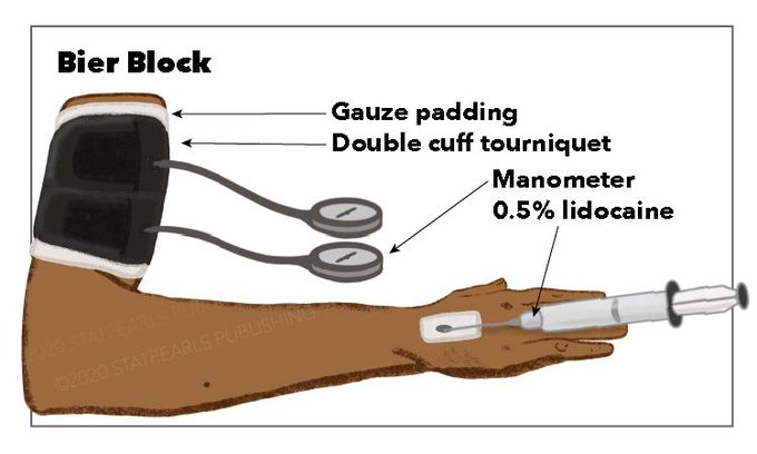 Bier Block