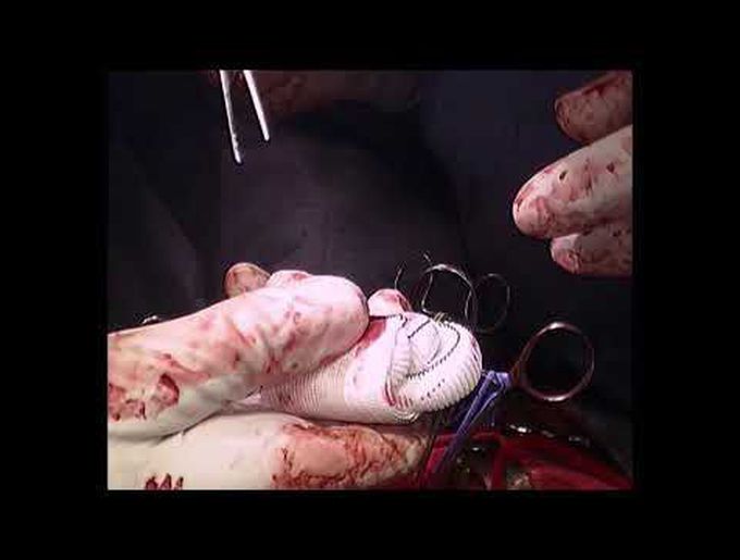 Hybrid Aortic Type I Dissection Repair