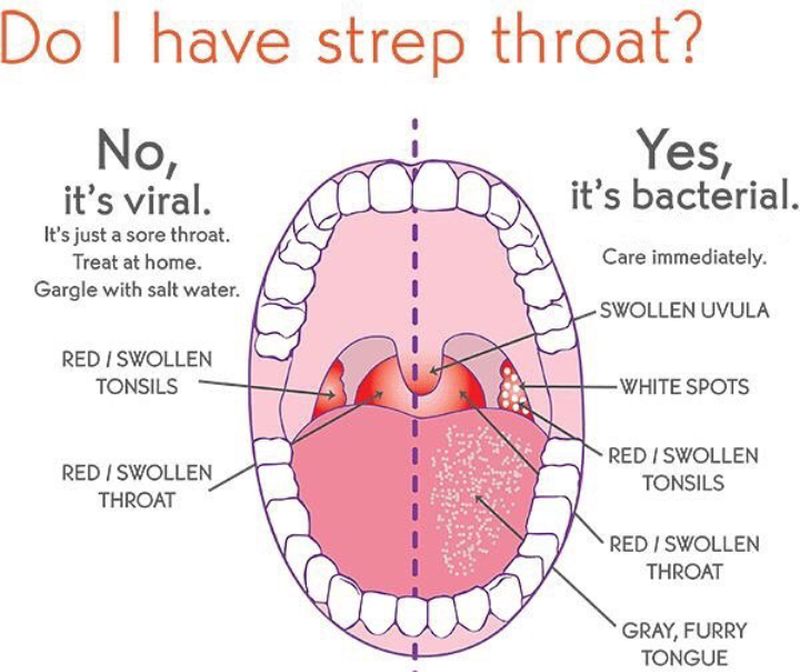 strep-throat-medizzy