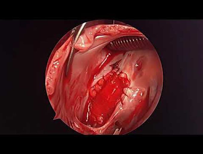 Surgical Treatment of Pulmonary Artery Sling
