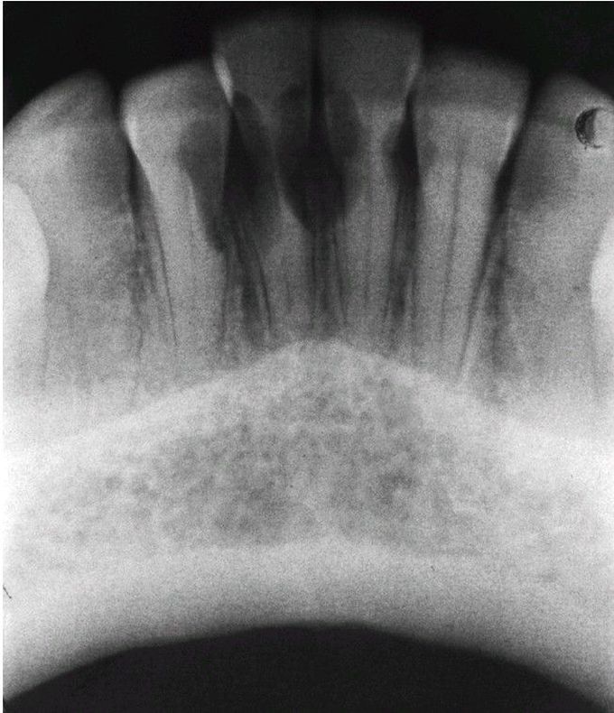 Multiple Idiopathic Root Resorption.