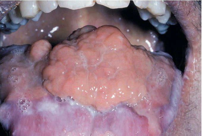 Nongingival Cyclosporine Hyperplasia.