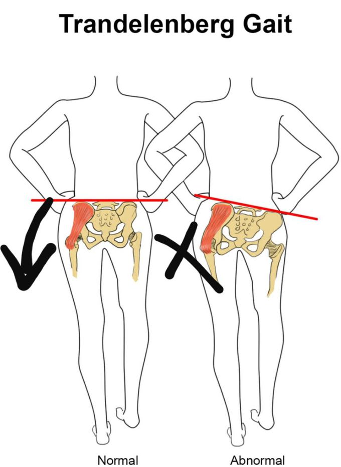 Trendelenburg gait (confusing but interesting😁)