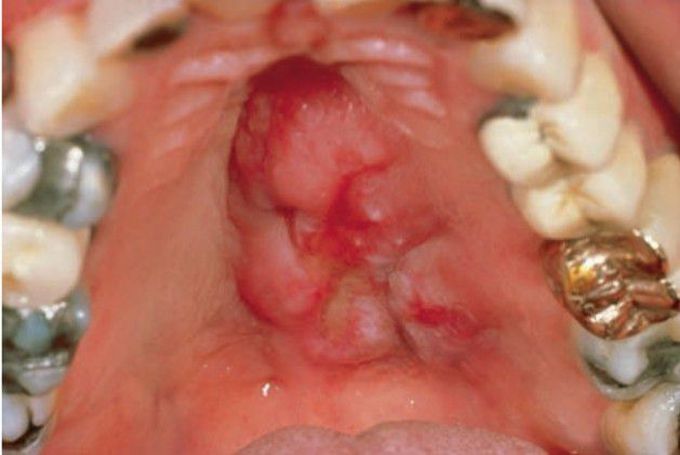 Lymphoma of palate