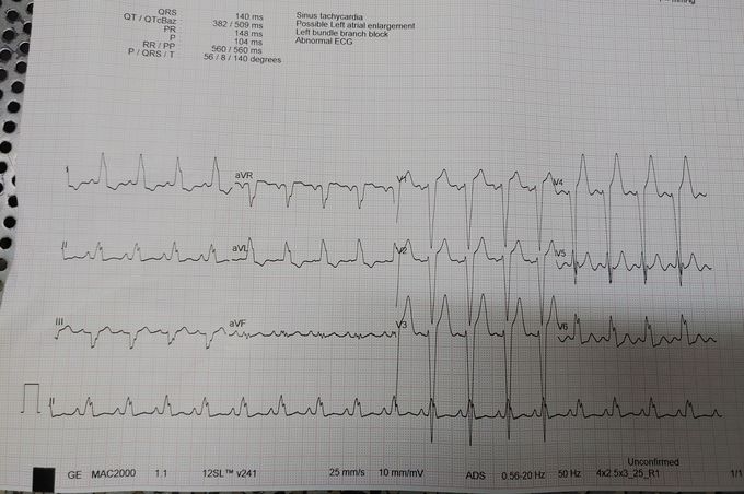 Dont skip read the case😊😊😊 A patient complaining severe breathlessness age 55 women while walking or doing work she is feeling pain in heart doctor checked ultrasound x ray done heart is enlarged ECG is abnormal left atrial enlargment