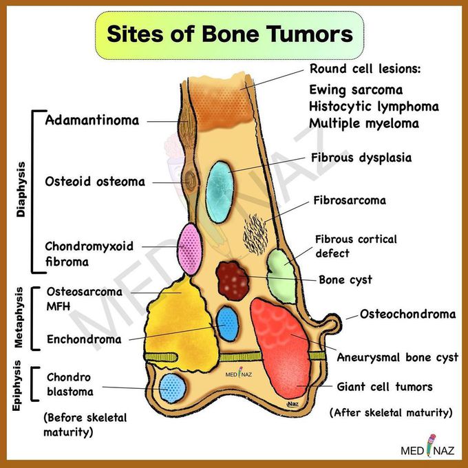 Sites of different bone tumor