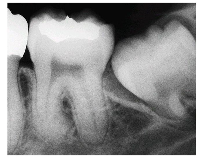 Large follicular sac.