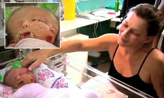 Baby with two faces: Australian woman gives birth to conjoined twins