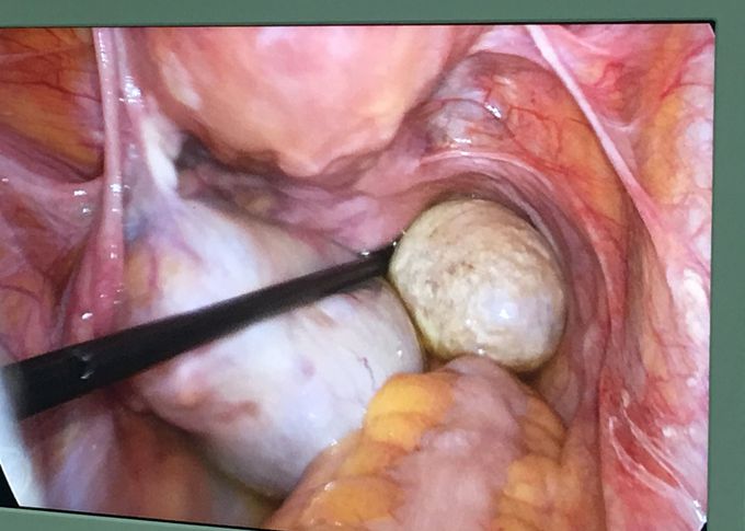 Teratoma