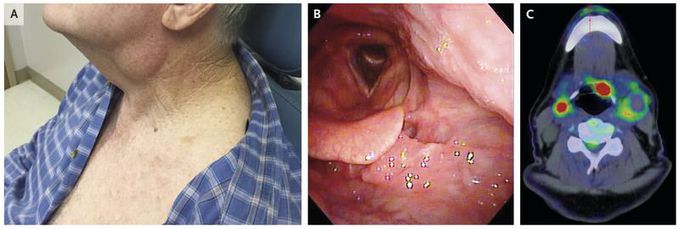 Human Papillomavirus–Associated Oropharyngeal Squamous-Cell Carcinoma