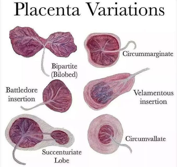 Placental Variations