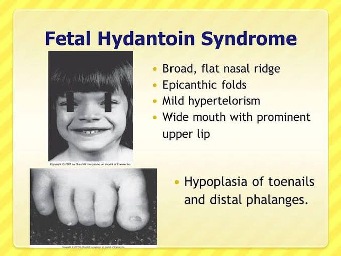 These are the symptoms of Fetal Hydantoin syndrome