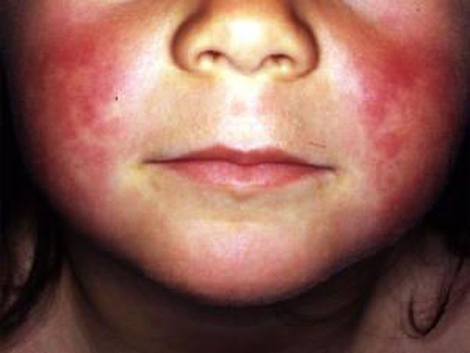 Circumoral pollar of scarlet fever