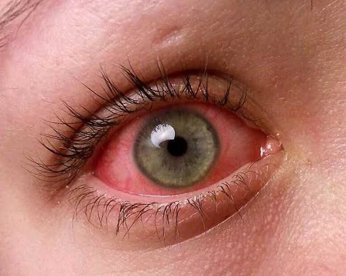 Conjunctivitis