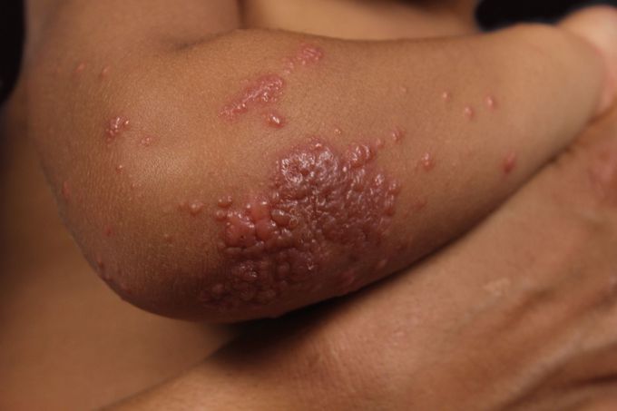 Gianotti-Crosti Syndrome