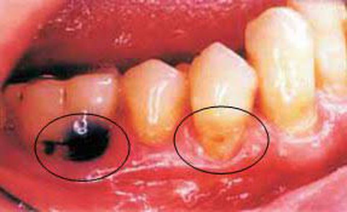 Root caries causes
