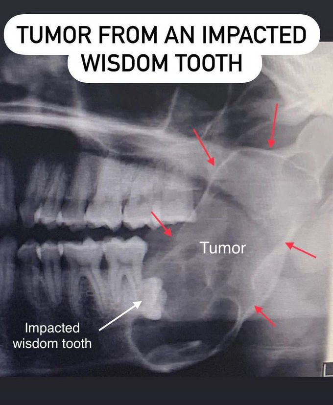 Tumor from an impacted 3rd Molar