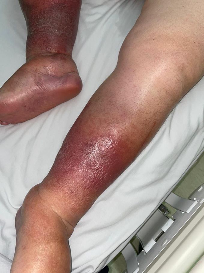 Cellulitis