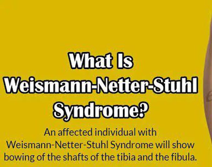 This is the symptom of Weismamn netter stuhl syndrome