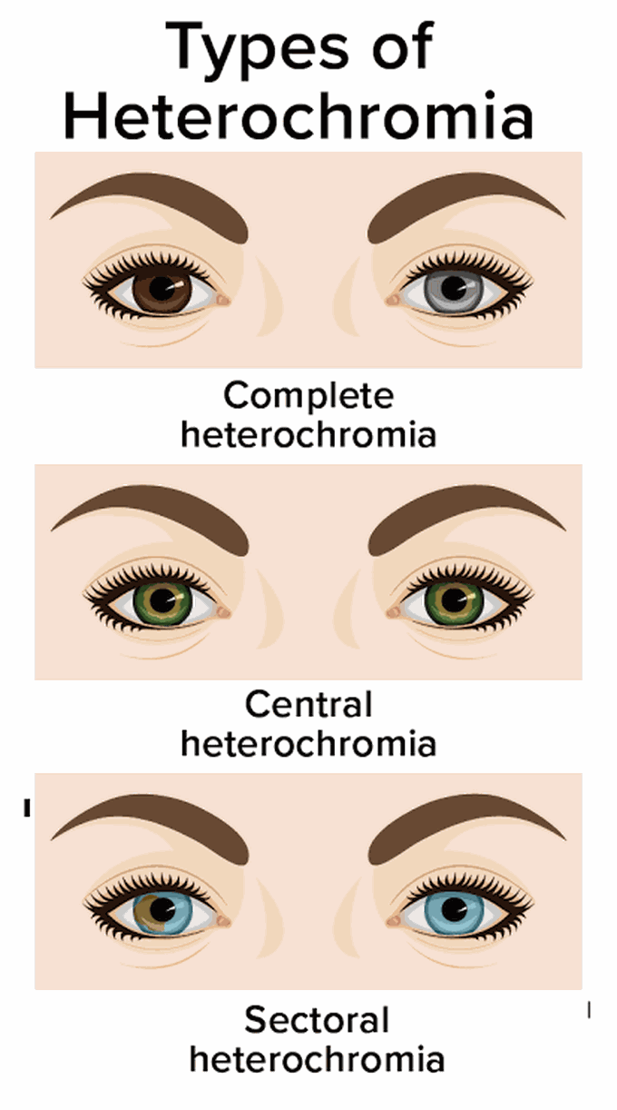 Types of heterochromia