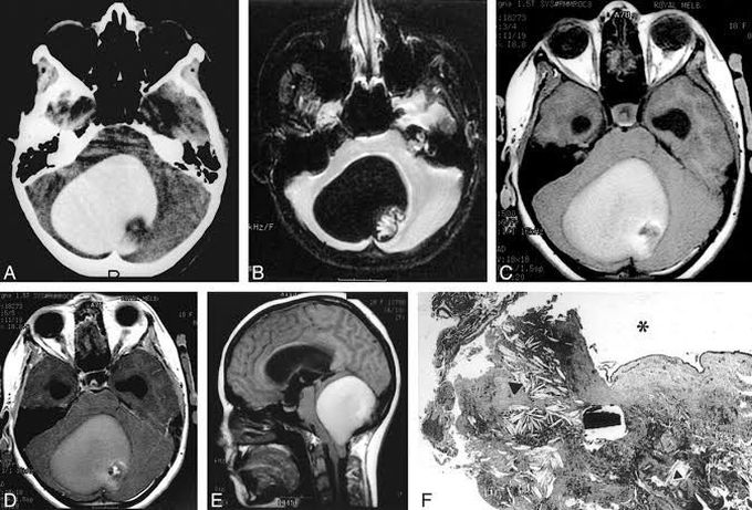 Intracranial dermoid cyst