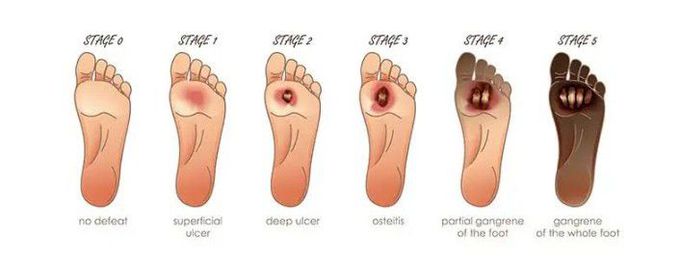 Stages of Diabetic Foot