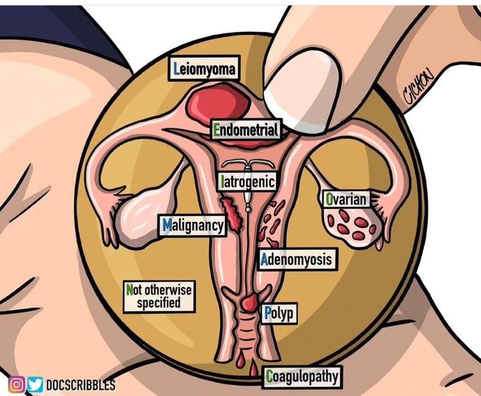 Causes of Abnormal Uterine Bleeding