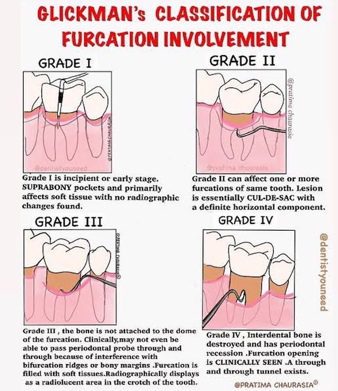 Grades of furcation