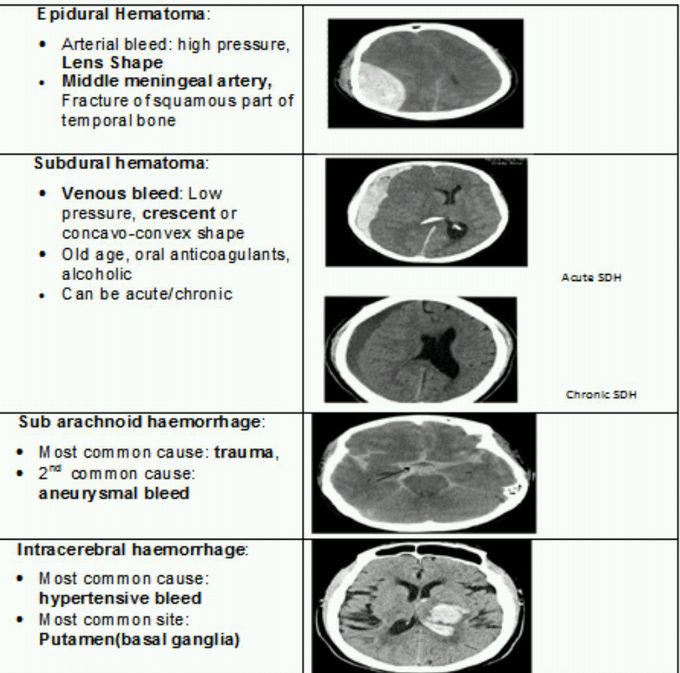 Intracranial bleed