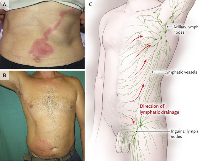 Lymphangitis on the Abdomen - MEDizzy