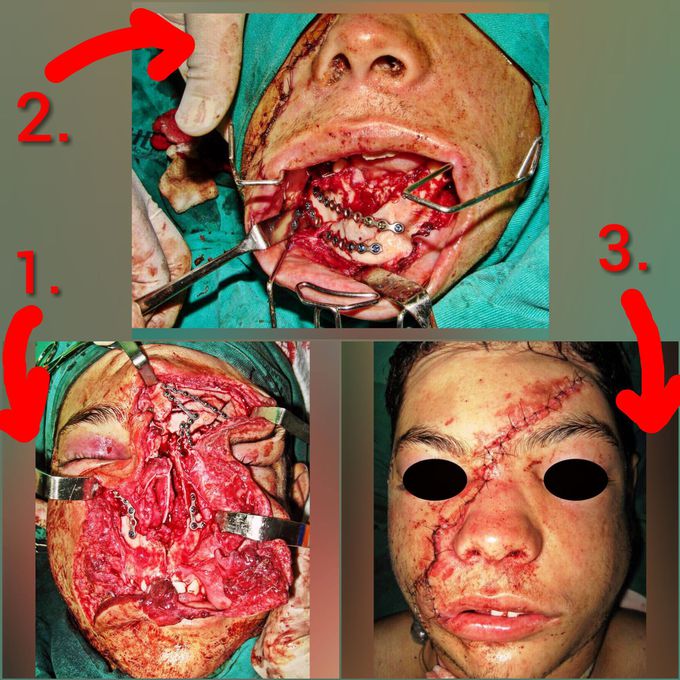 Case sequence (maxillofacialsurgery)