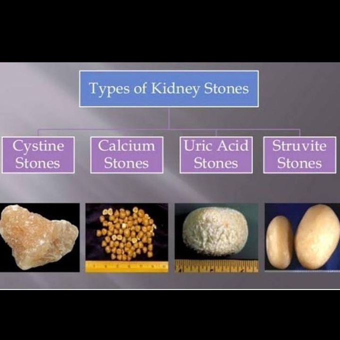 Types of kidney stones