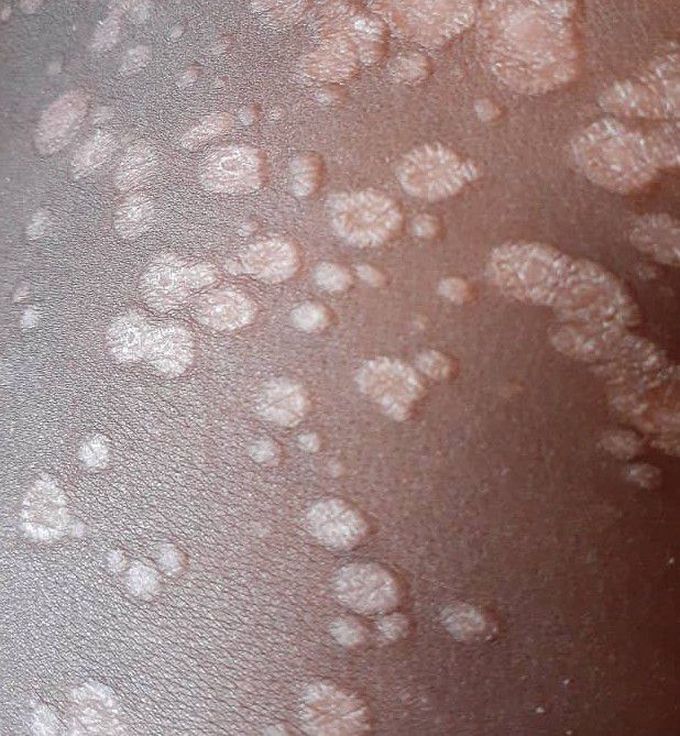 SKIN CONDITION