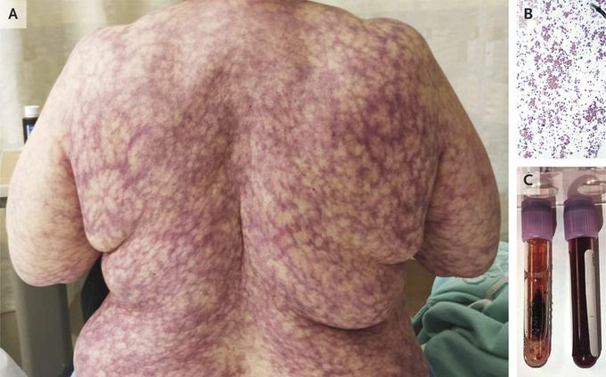 Livedo Reticularis in Cold Agglutinin Disease