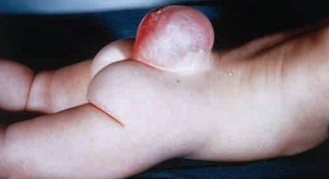 MENINGOCELE