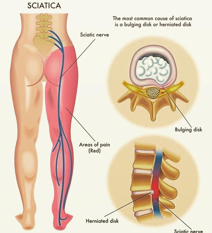 Sciatica