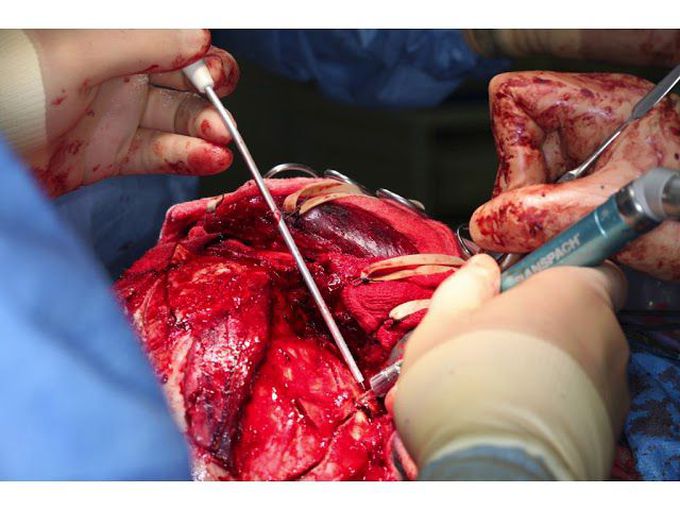 Craniofacial trauma repair