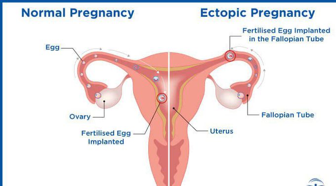 Ectopic pregnancy