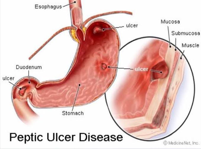 PEPTIC ULCER DISEASE (PUD)