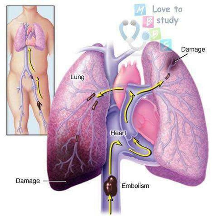 Pulmonary embolism process