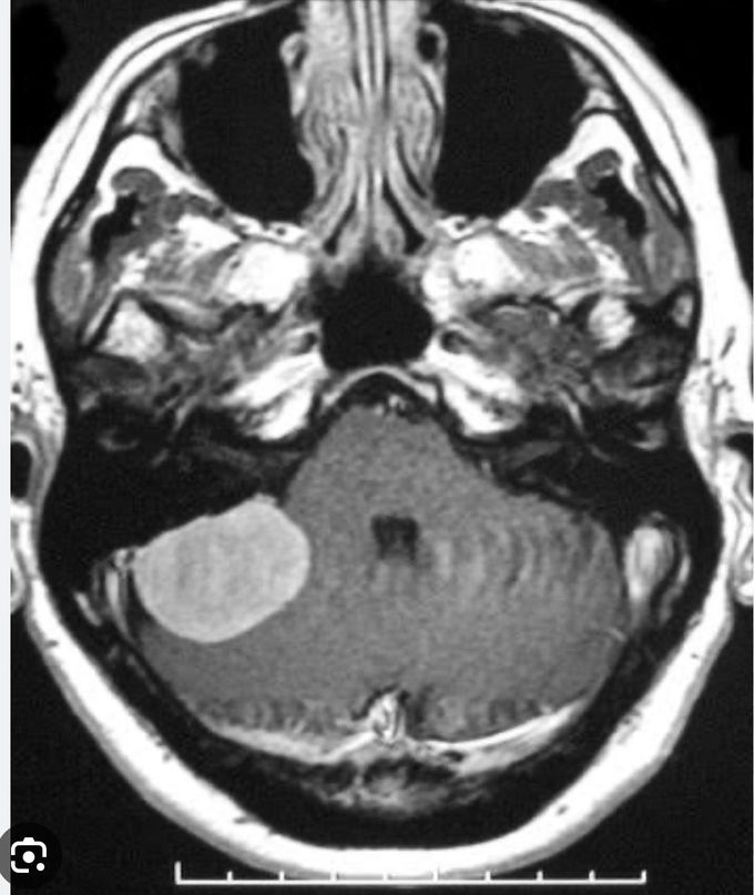 Cerebellopontine angle (CPA)