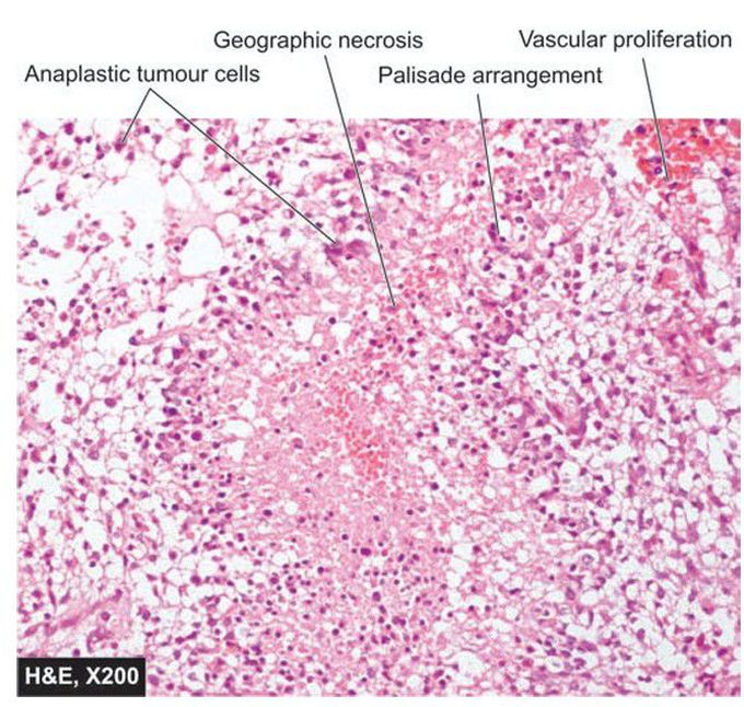 Glioblastoma multiforme (WHO grade IV astrocytoma).