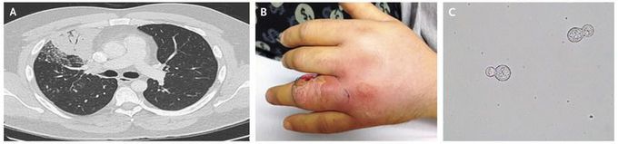 Disseminated Blastomycosis