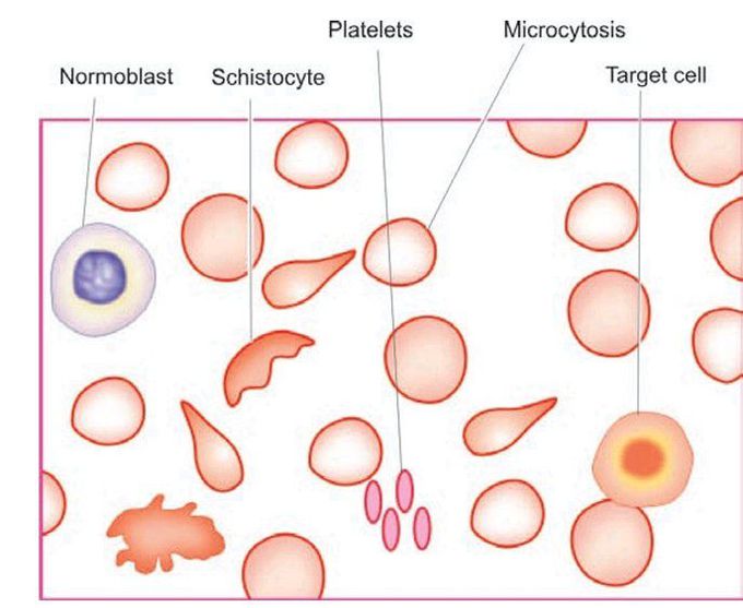 β-thalassaemia major.