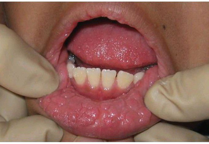 Multifocal Epithelial Hyperplasia